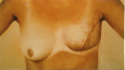 Borst reconstructie 2 Borst reconstructie 2